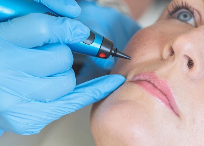 CryoPen cryotherapy treatment
