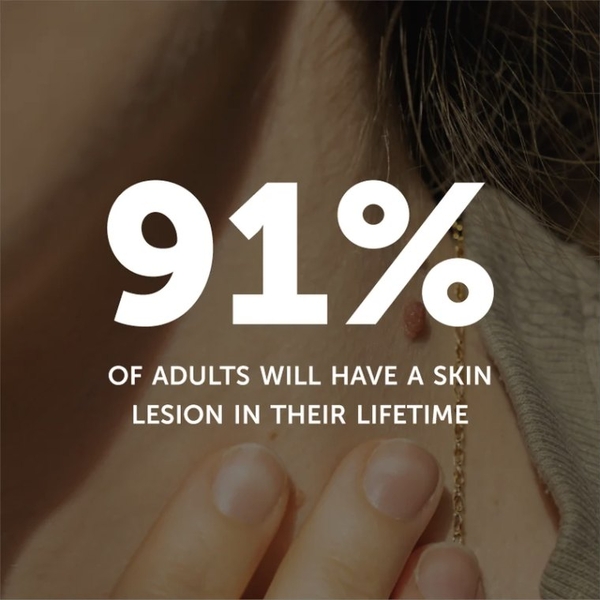 91% of adults will have a skin lesion in their lifetime