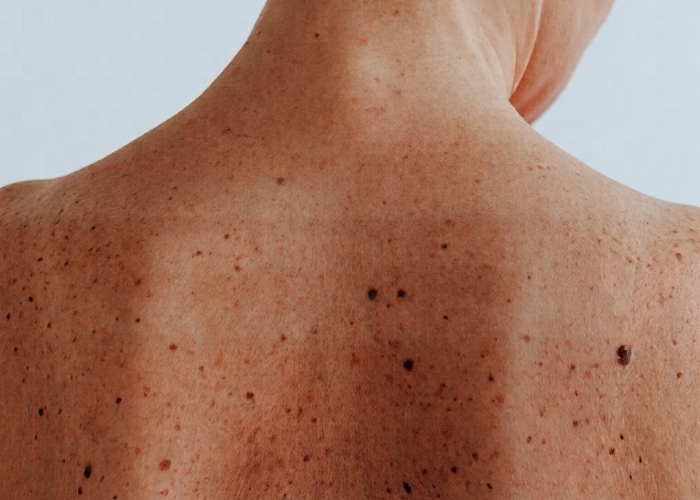 Mole and skin lesion assessment