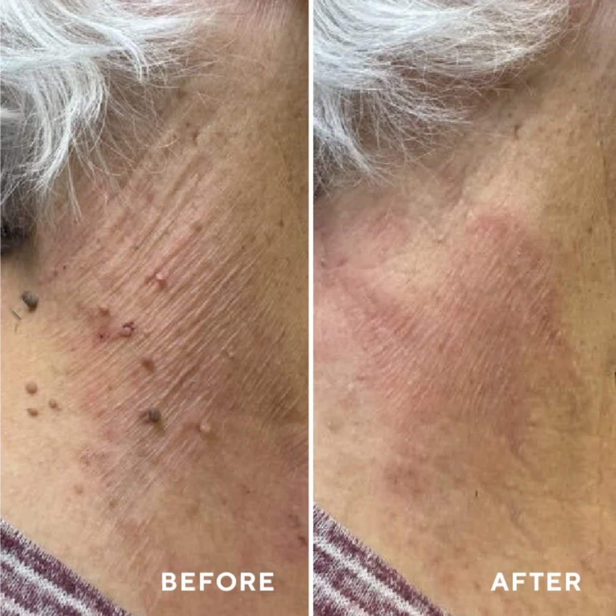 Cryotherapy before and after - skin tags on the neck