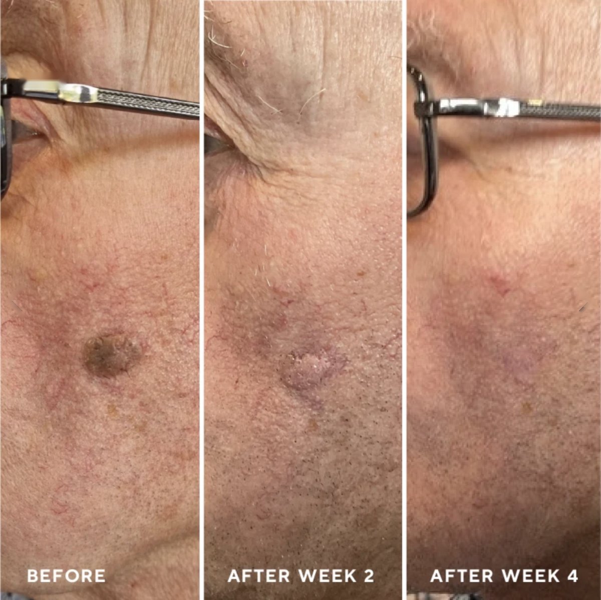 Cryotherapy before and after - lesion on the cheek, weeks 2 and 4
