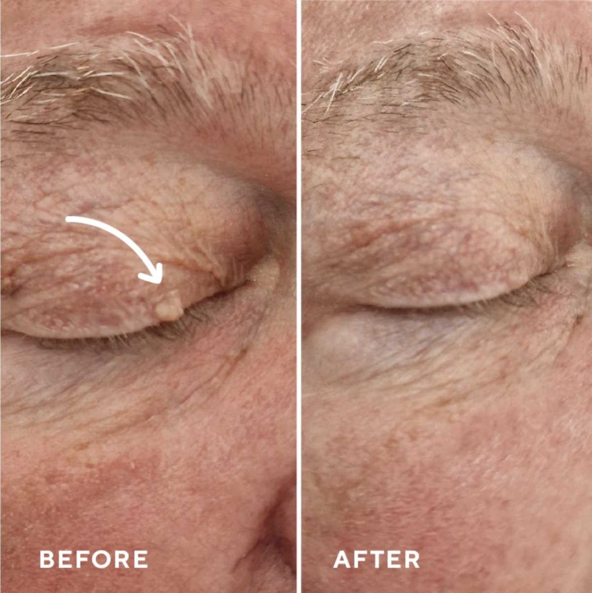 Cryotherapy before and after - lesion on the eyelid