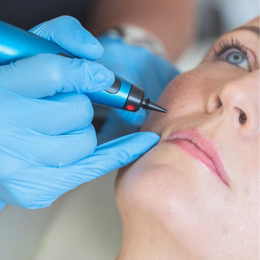 CryoPen cryotherapy treatment