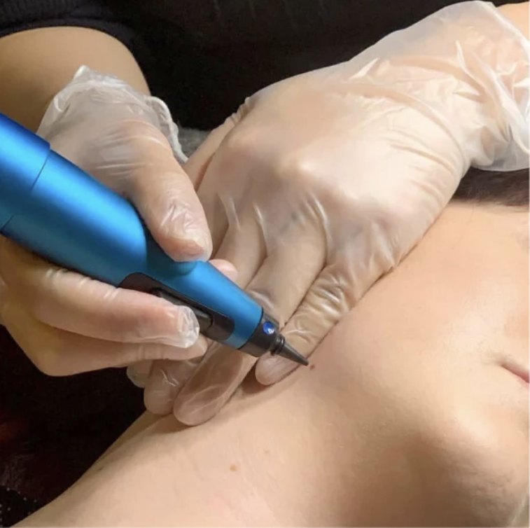 CryoPen treating a skin lesion on the neck