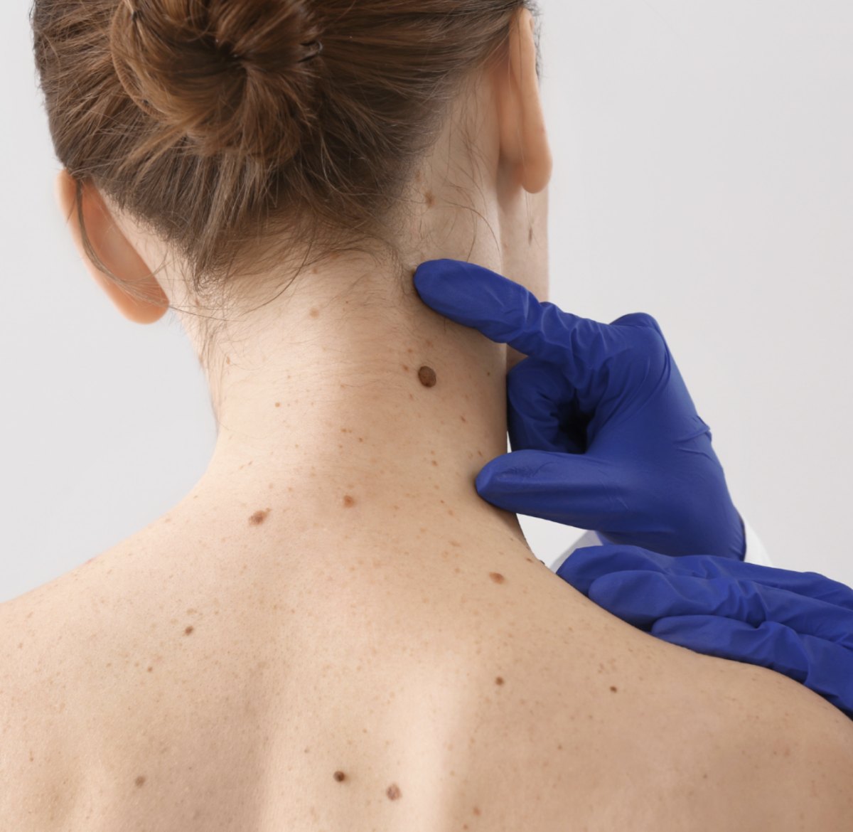 Clinician examining a mole on a patient's neck